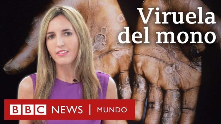 Cuáles son los síntomas y cómo se transmite la viruela del mono | BBC Mundo